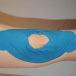 Knieerguss-18-1-e1455882003474-201x300